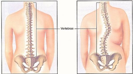 7-skolioza-za-opravqne
