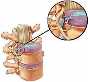 herniadiscalis2
